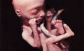 Abortion: Setting the Matter Straight